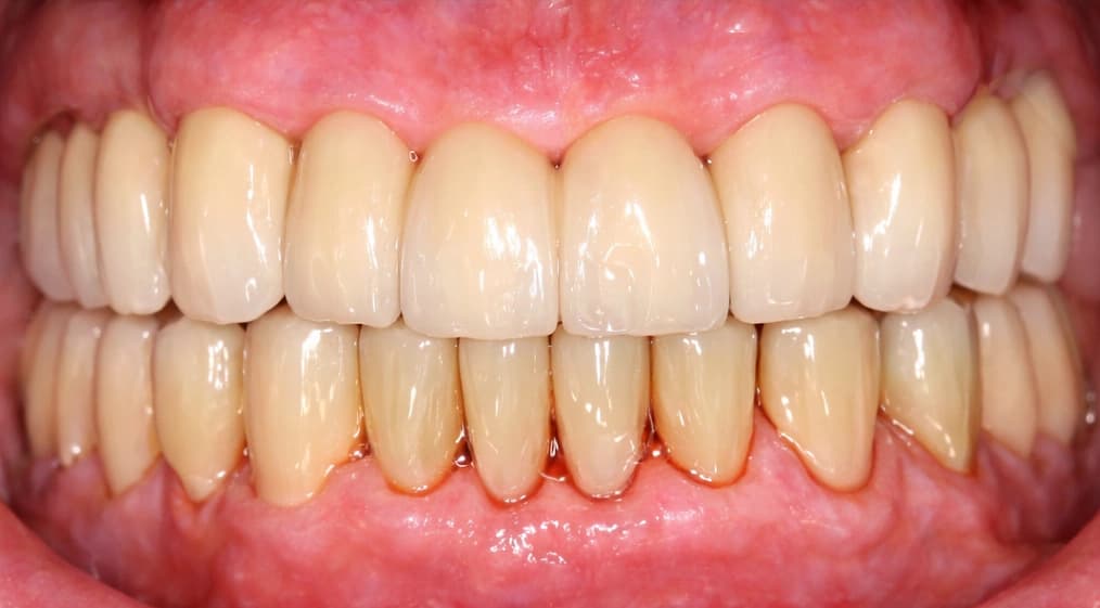 Dental Implants - After treatment at Cosmodocs